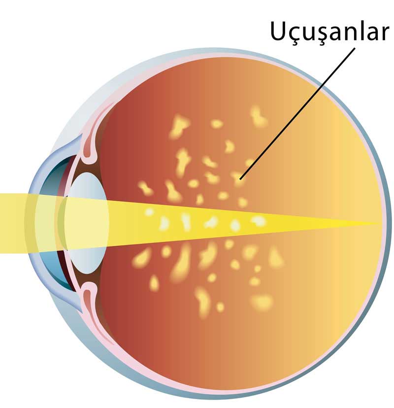 Vitreus Dejenerasyonu