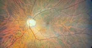 tavuk karası ve okuvizyon tedavisi