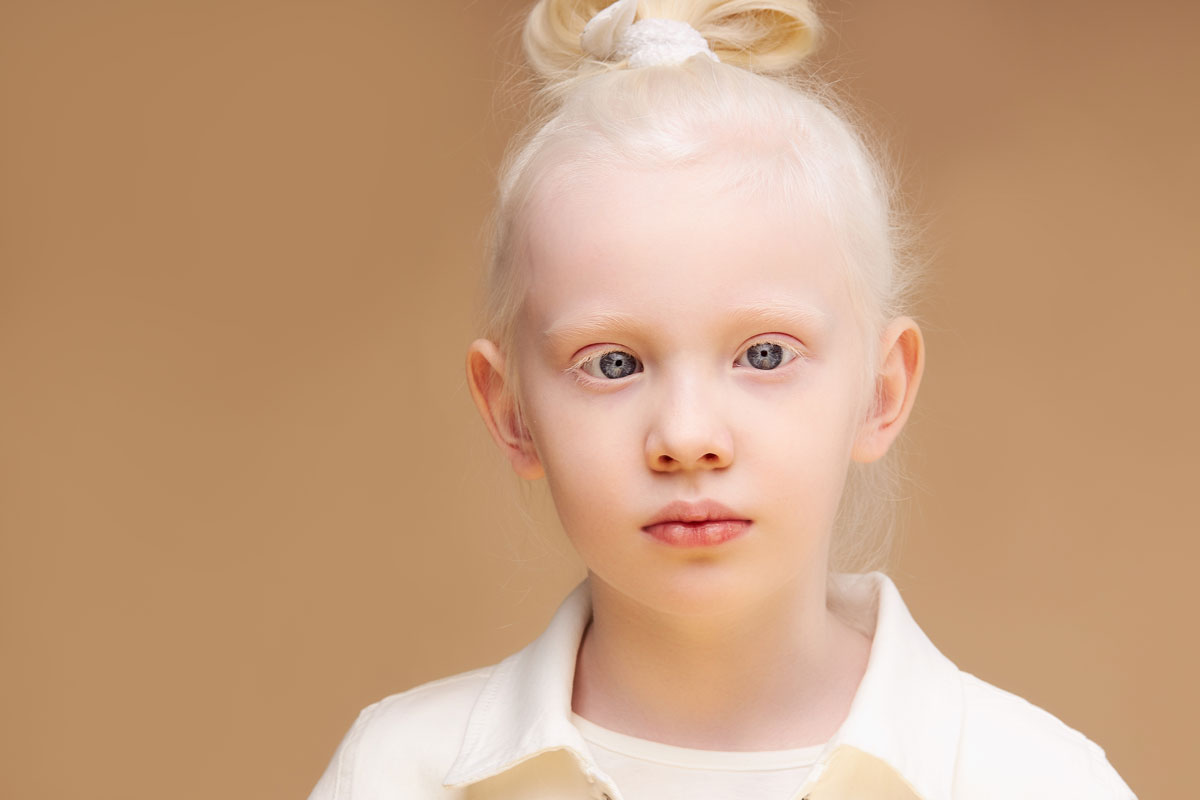 Albinizm (Albino) Nedir?