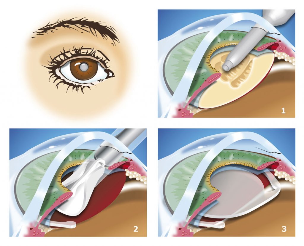 Akıllı Lens Operasyonu-Katarakt Ameliyatı
