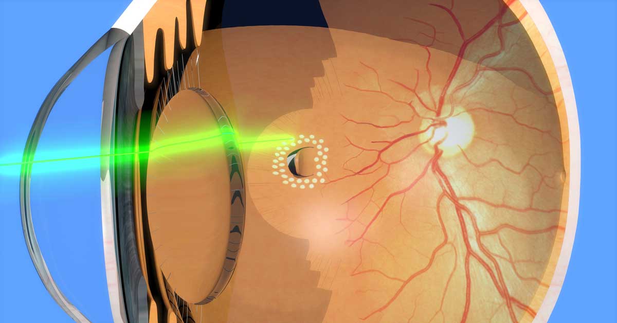 Retina Yırtılması Kör Eder Mi?