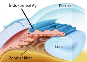 Göz Tansiyonu Hastalarında Katarakt Ameliyatı