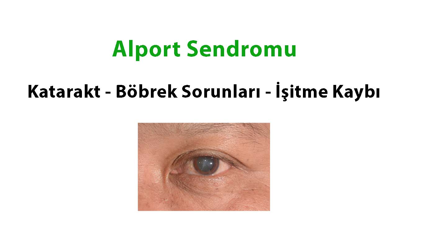 Alport Sendromu ve Göz Sorunları