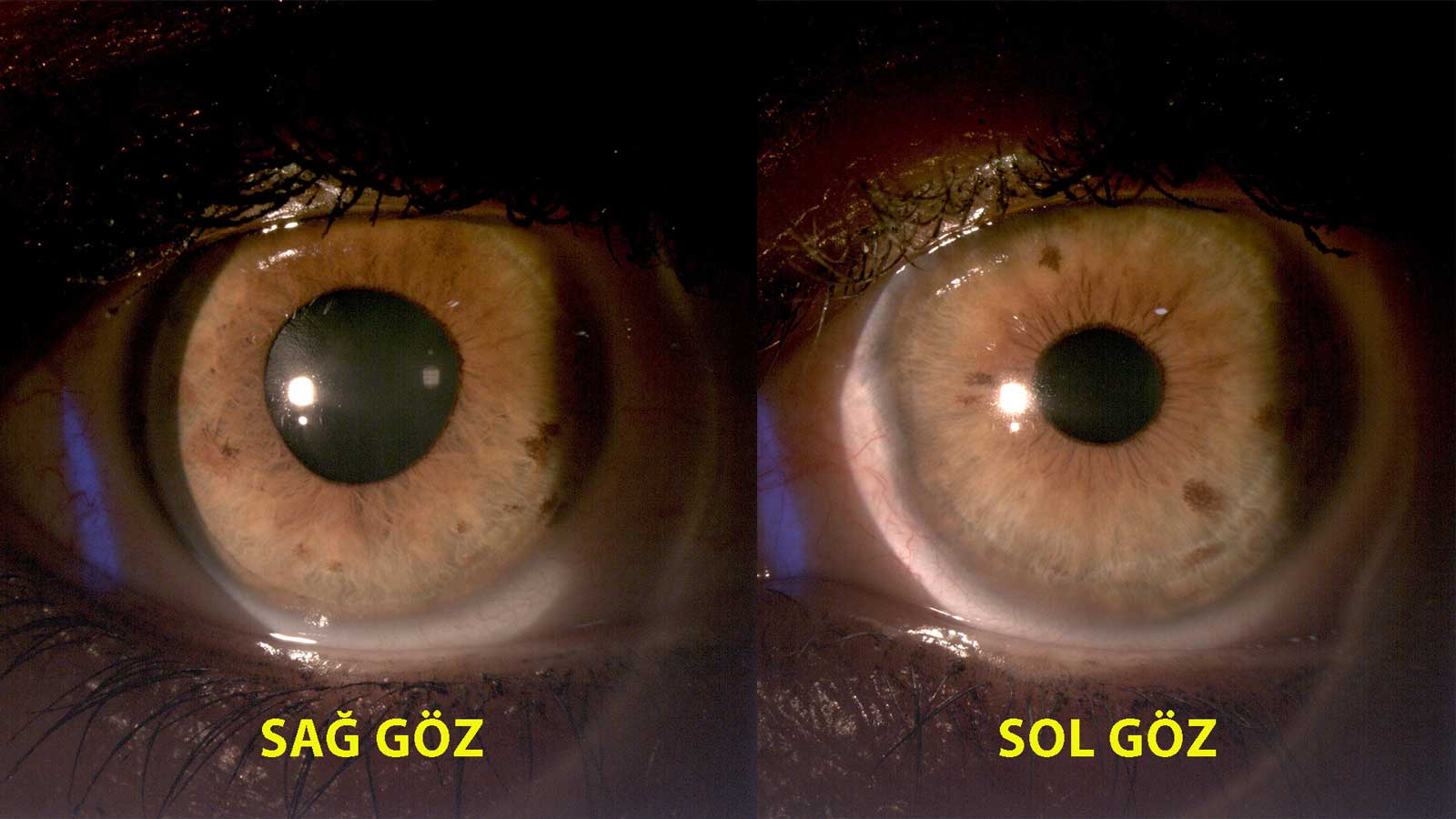 Anizokori Nedir?