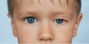 Çocuklarda Göz Kapak Düşüklüğü-Konjenital Pitosiz