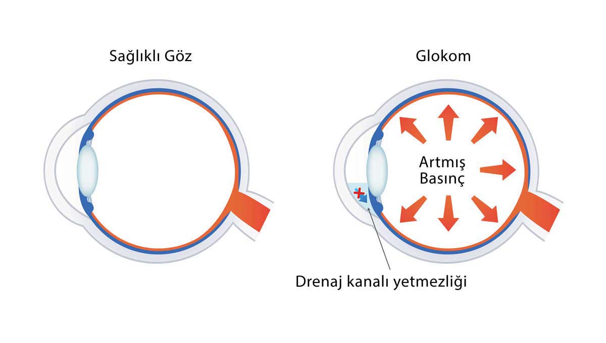Dar Açı, Katarakt ve Göz Tansiyonu İlişkisi - Fakomorfik Glokom