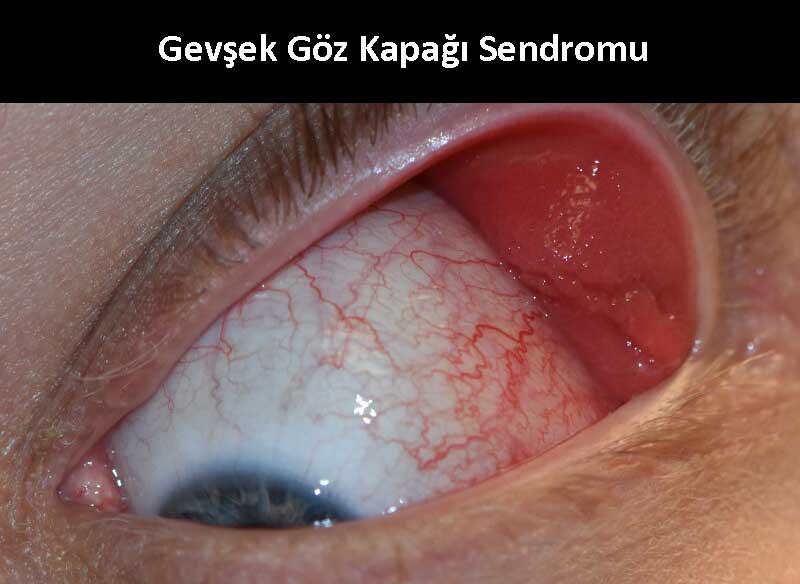 Gevşek Göz Kapağı Sendromu