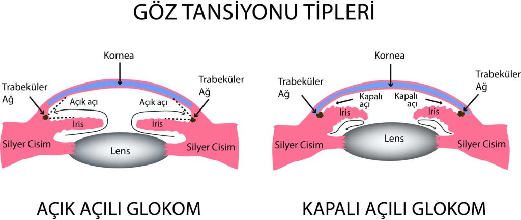 Açık açılı Glokom-Kapalı Açılı Glokom