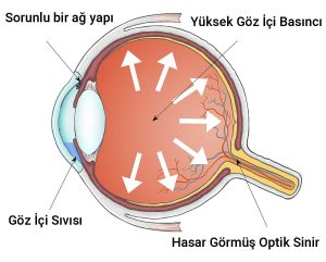 Glokomda göz içi basıncın artmasıyla göz siniri başında (optik disk) hasar oluşmasını gösteren şematik göz görseli