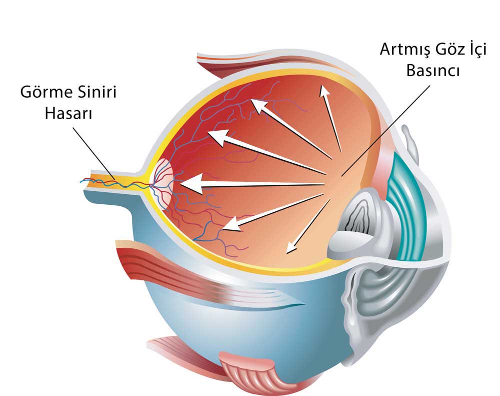 Göz Tansiyonu Tanısında Kontakt Lens Geliştirilmesine Yönelik Bilimsel Gelişme