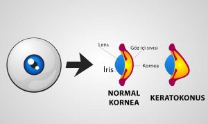 Keratokonus ve Kornea Sivrileşmesi