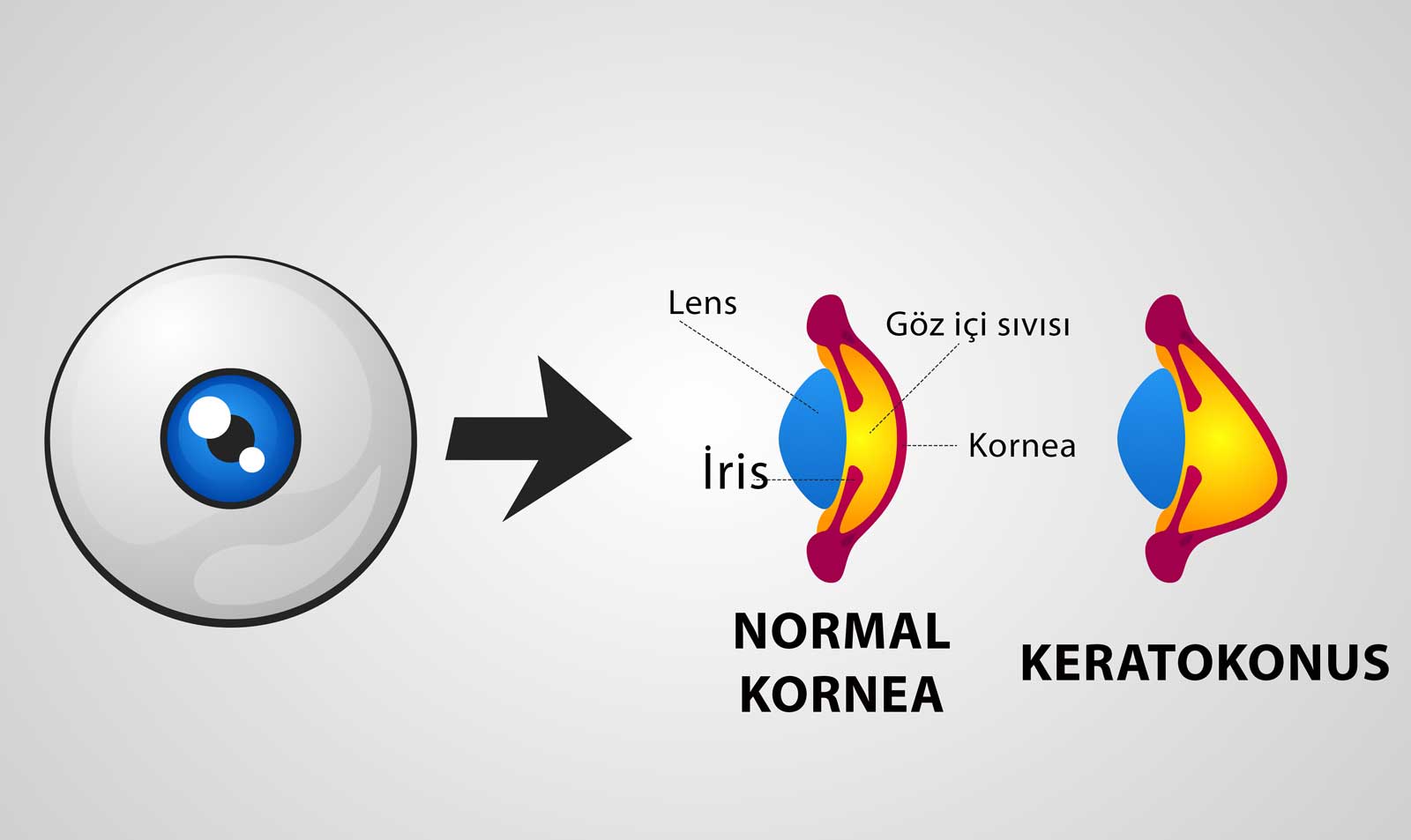 Keratokonus Hastaları Lazer Olabilir Mi?