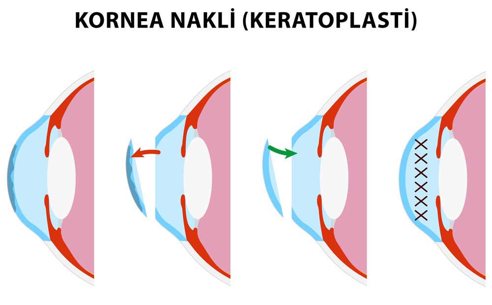 Kornea Nakli-Keratoplasti