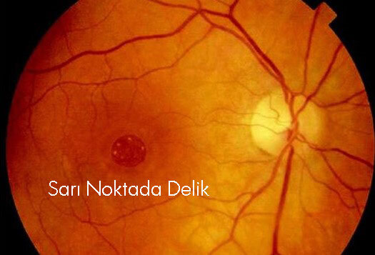 Maküla Deliği (Maküler Hole) Nedir?