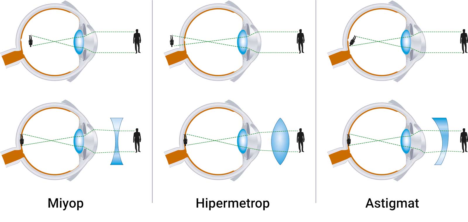 Astigmata Lazer Yapılır mı?