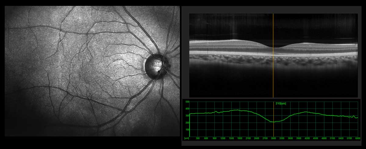 OCT Testi (Optik Koherens Tomografi)