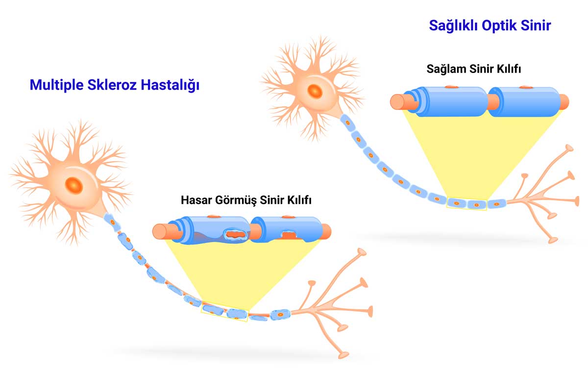 MS Hastalığı ve Göz
