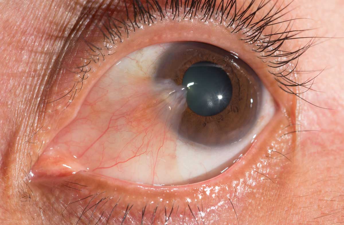 Pterjium (Kuş Kanadı)