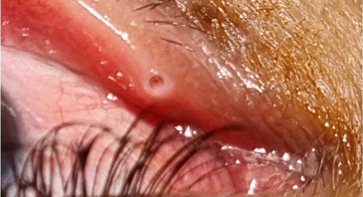 Punktoplasti Nedir?