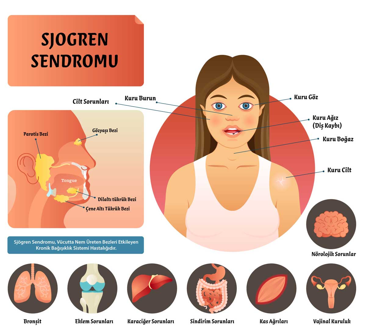 Sjögren Sendromu ve Göz