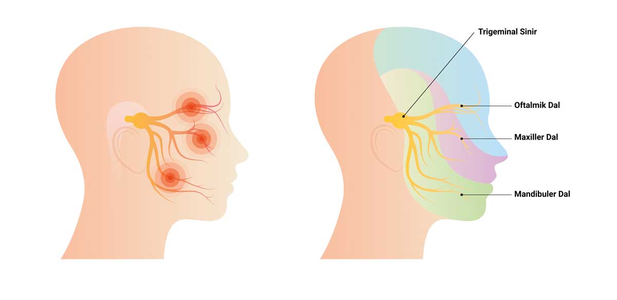 Trigeminal Nevralji