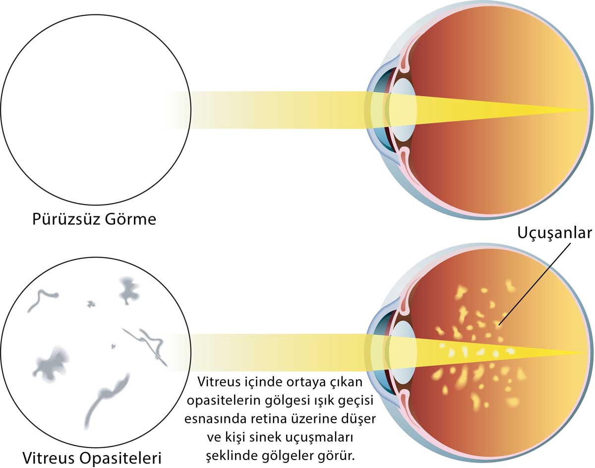 Vitreus Dejenerasyonu-Gözde Uçuşmalar-Vitreus Opasitesi