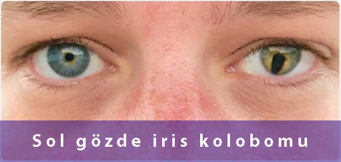 Kolobom