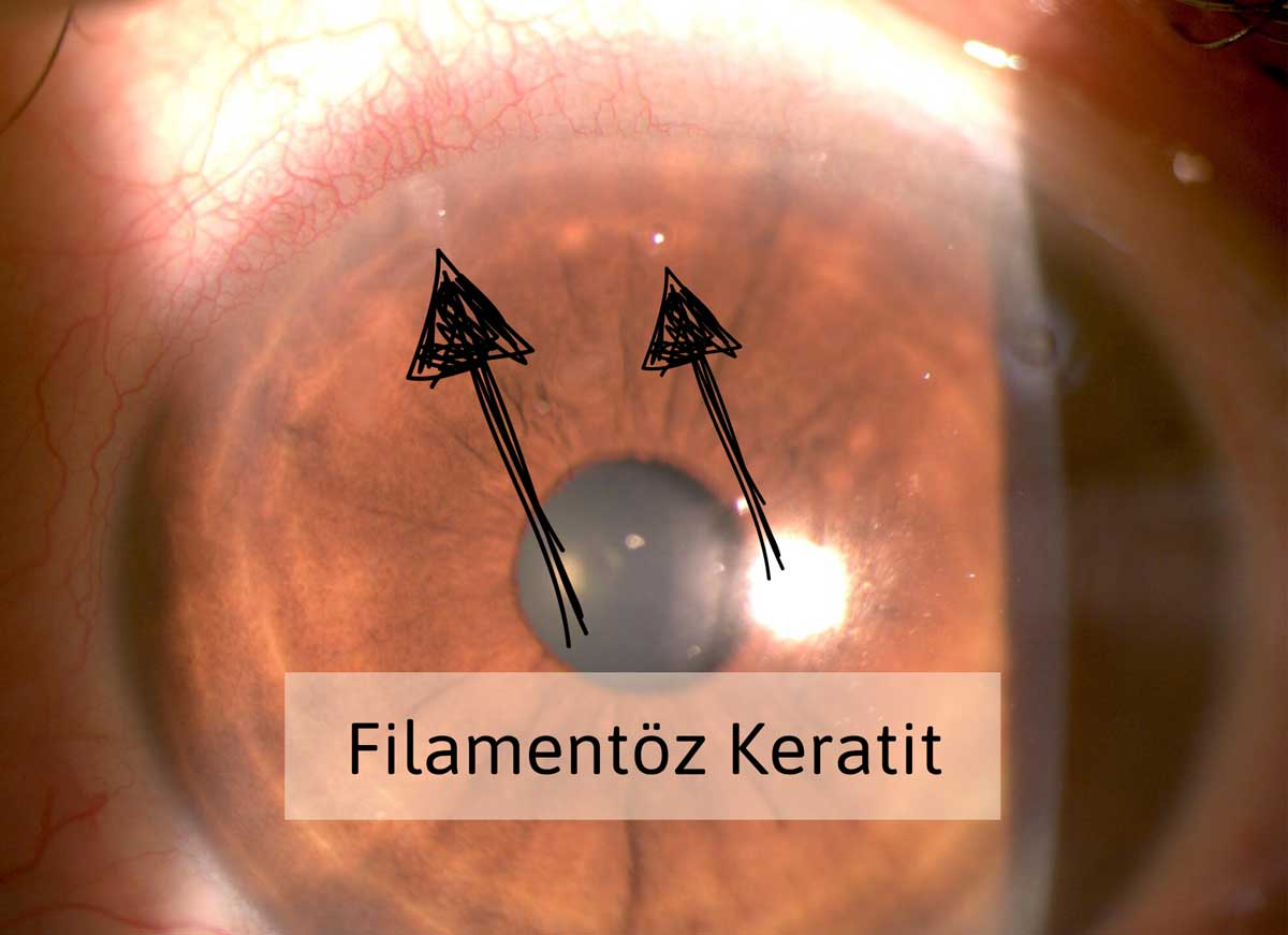Filamentöz Keratit Nedir? Belirtileri Nedir? Tedavisi Nasıl Yapılır?