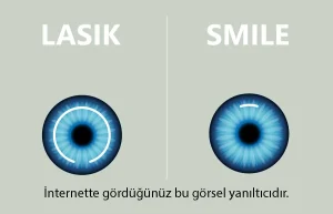 SMILE Laser ve Femto-LASIK’te korneadaki kesi yaklaşımını temsilî olarak gösteren, basitleştirilmiş ve yanıltıcı olabilecek şematik görsel