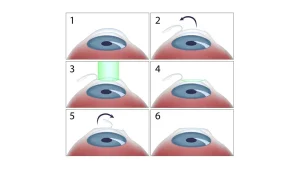 LASIK lazer uygulamasını simgeleyen şematik göz ve lazer görseli