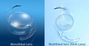 Akıllı Lens-Multifokal Lens-Trifokal Lens