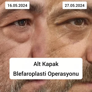 Alt kapak blefaroplasti ameliyatı öncesi ve sonrası görünüm. Göz altı torbalanması ve yağ fıtıklaşmasının giderildiği hasta sonucu.
