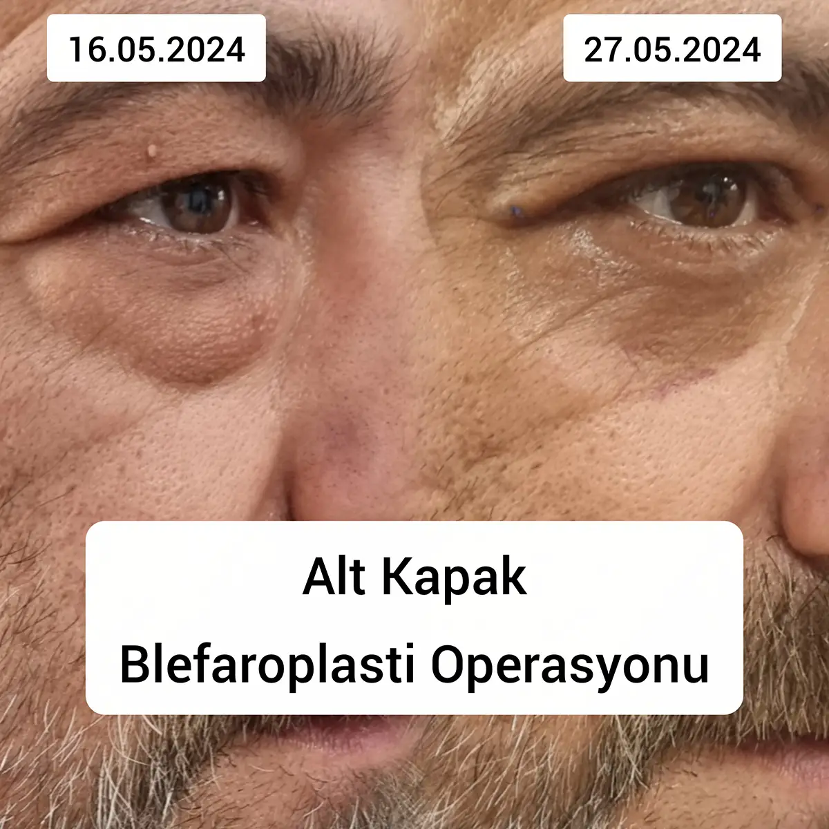 Alt Göz Kapağı Torbalanması Ameliyatı Nasıl Yapılır?
