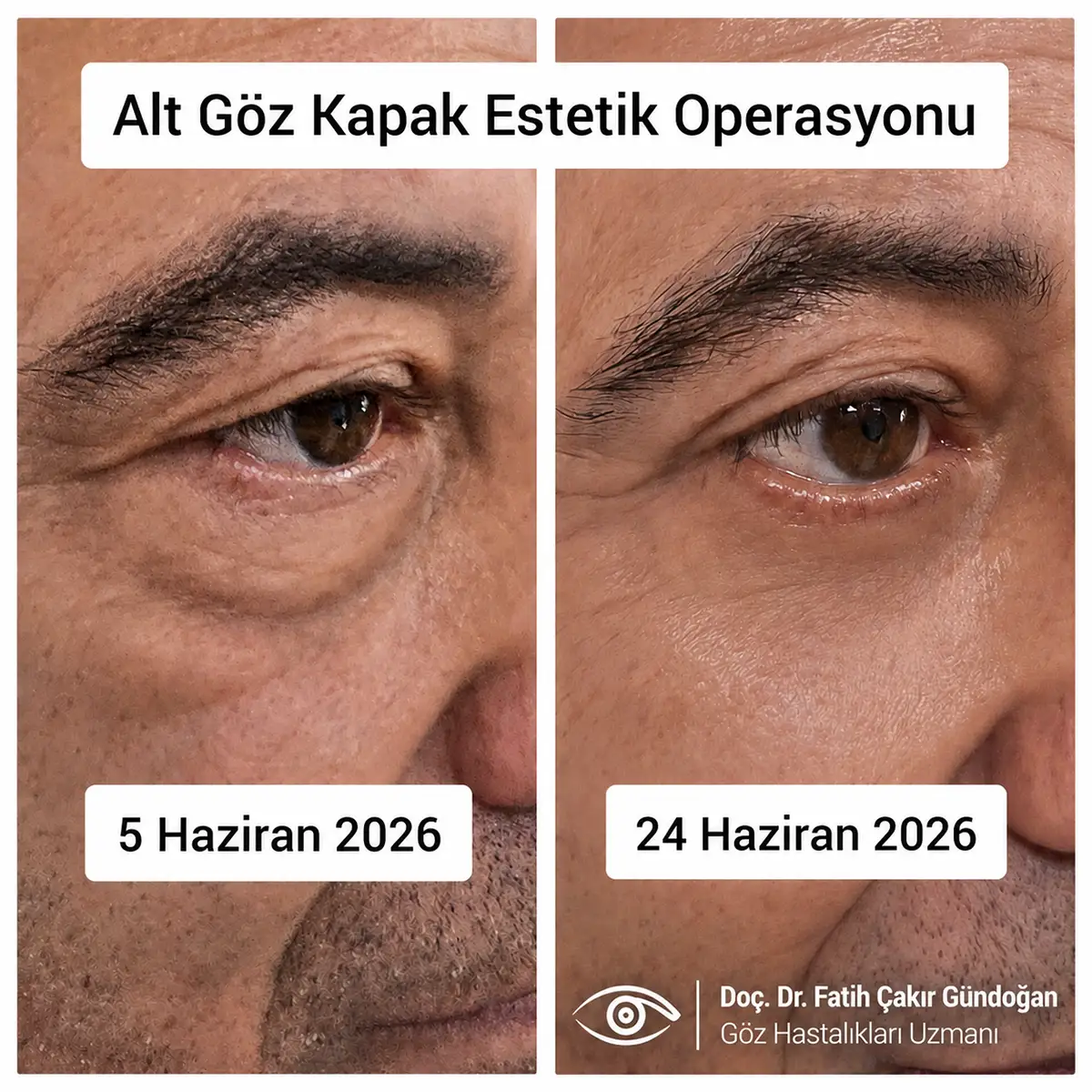 Göz Kapak Estetiği Nedir?