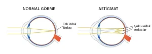 Normal gözde ışınların retina üzerinde tek noktada odaklanması ve astigmatlı gözde ışığın retina üzerinde birden fazla noktaya odaklanmasını gösteren şema