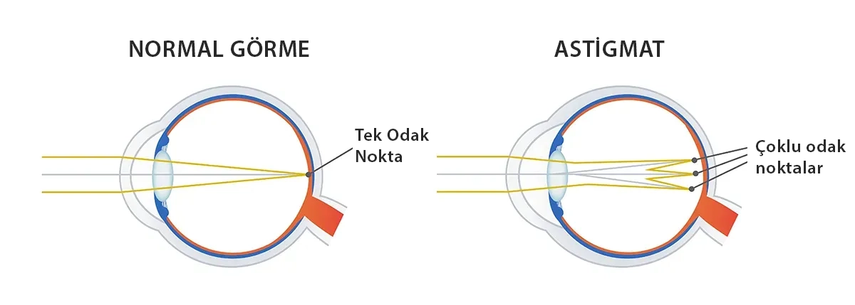 Astigmat nedir?