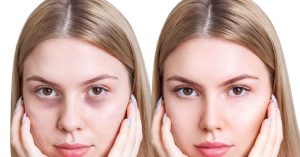 Göz çevresi koyuluğu olan ve tedavi sonrası görünümü gösteren öncesi–sonrası karşılaştırma