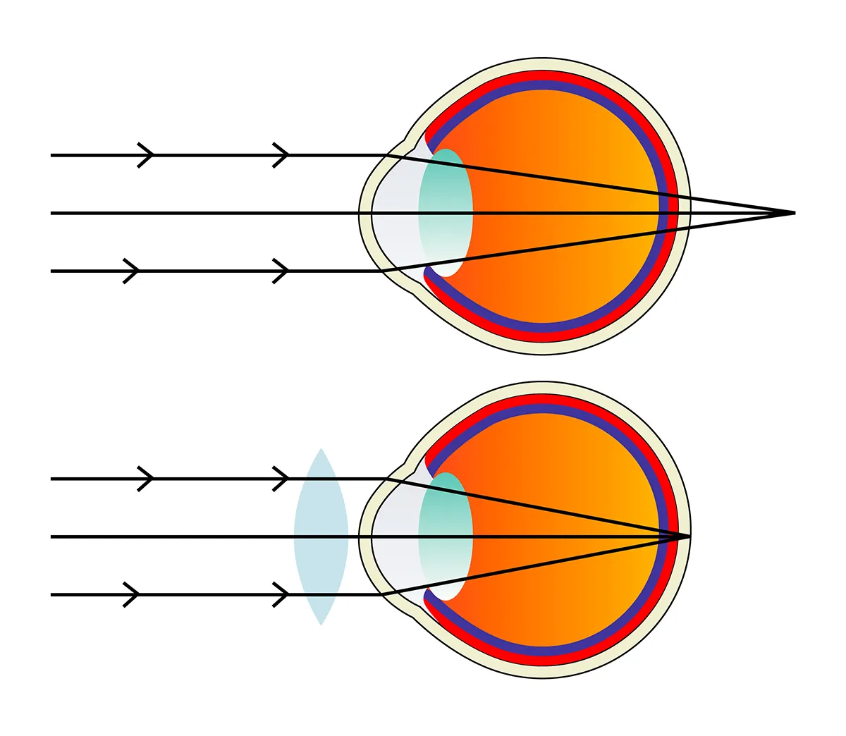 Hipermetrop nedir?