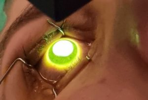 Keratokonus tedavisinde uygulanan cross-linking işlemi sırasında korneaya yapılan tedavi uygulaması