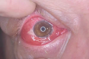 Alerjik konjonktivit nedeniyle kızarmış ve kaşıntılı göz