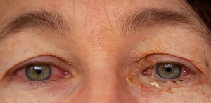Bakteriyal konjonktivit nedeniyle yoğun sarı çapak oluşmuş göz