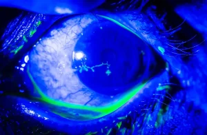 Herpetik keratit (göz uçuğu) nedeniyle korneada enfeksiyon gelişmiş göz görüntüsü