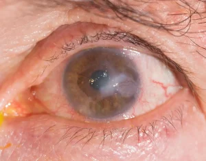 Keratit nedeniyle korneada opasite gelişmiş göz görüntüsü