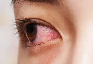 Konjonktivit nedeniyle kızarmış ve sulanan göz görüntüsü