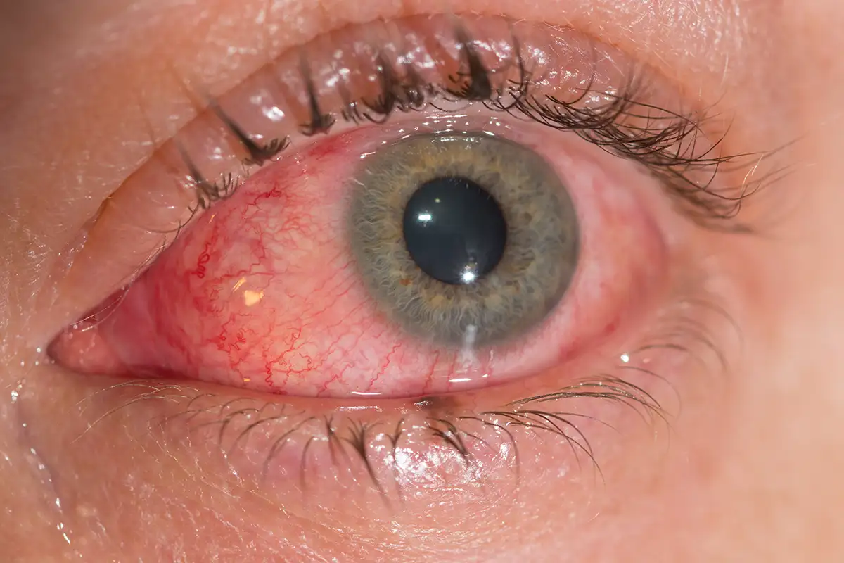 Viral Konjonktivit Nedir?