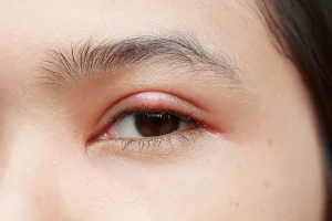 Alt göz kapağında arpacık bulunan hastanın göz kapağı şişliği ve kızarıklığı