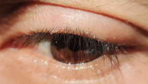 Blefarit hastasında kirpik diplerinde kızarıklık ve kabuklanma görünümü