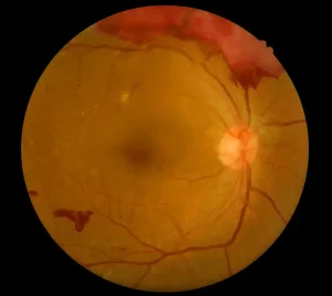 Diyabetik retinopatide retinada görülen kanamalar ve damar hasarını gösteren fundus görüntüsü
