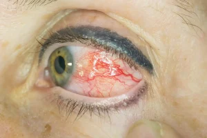 Episklerit nedeniyle gözün beyaz kısmında bölgesel kızarıklık görülen göz