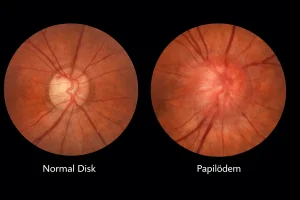 Normal optik disk ile papilödem bulunan optik diskin karşılaştırmalı fundus görüntüsü